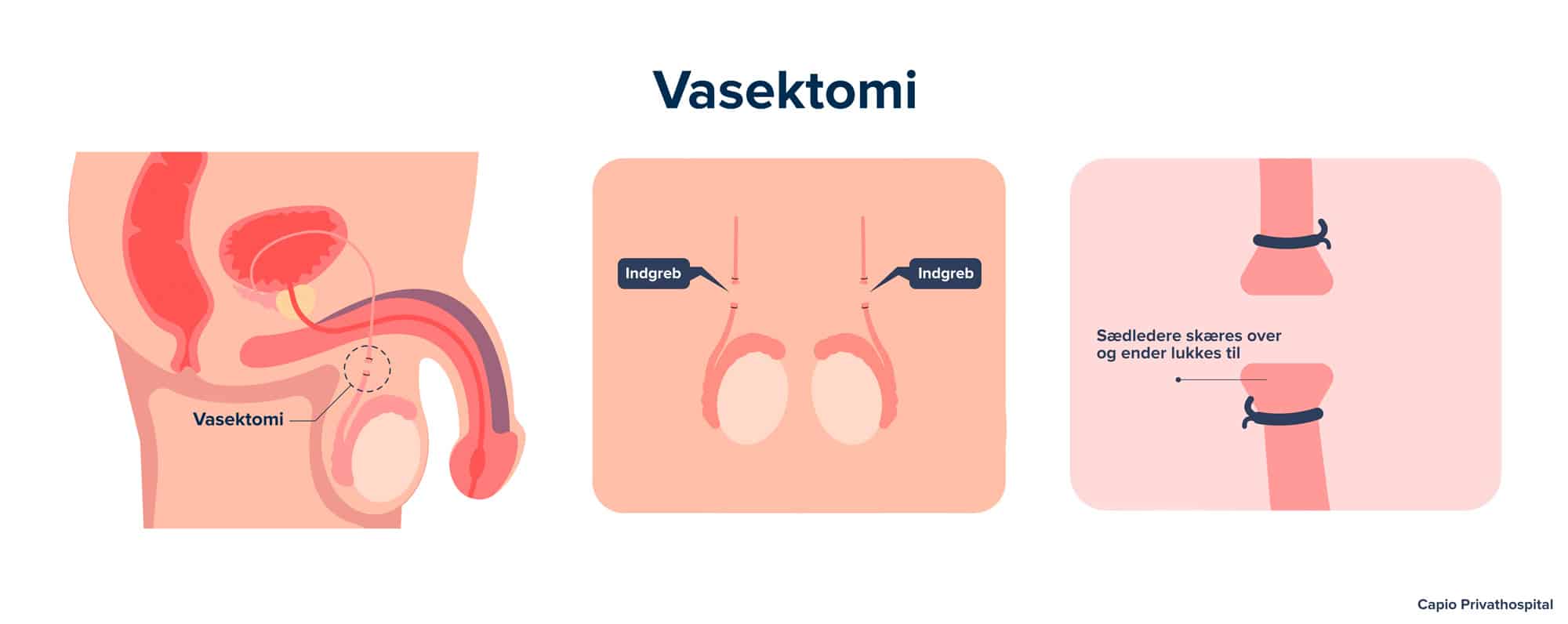 Vasektomi